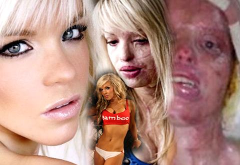 Katie Piper: vítima da excrescência humana